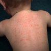 Bé bị mẩn ngứa như rôm: Nguyên nhân và Cách chăm sóc